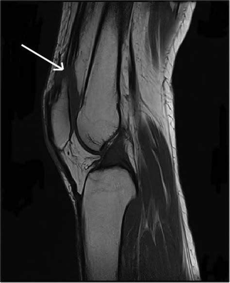 Frontiers Rebuilding Strength Surgical Intervention And