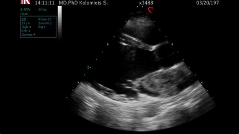 Echocardiogram Of Left Atrial Myxoma YouTube