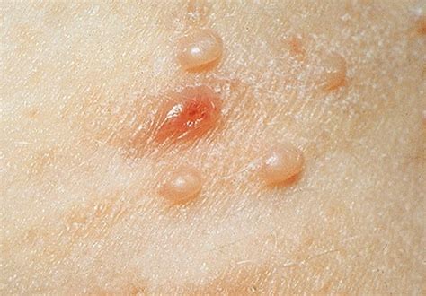 Molluscum Contagiosum Pictures Symptoms Treatment Causes Hubpages