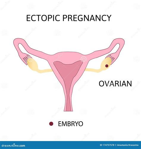 Types Of Ovarian Cysts Set Infographics Vector Illustration On