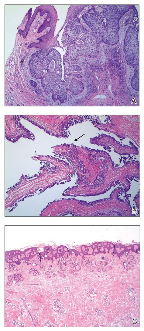 Collision Course Of A Basal Cell Carcinoma And Apocrine Hidrocystoma On