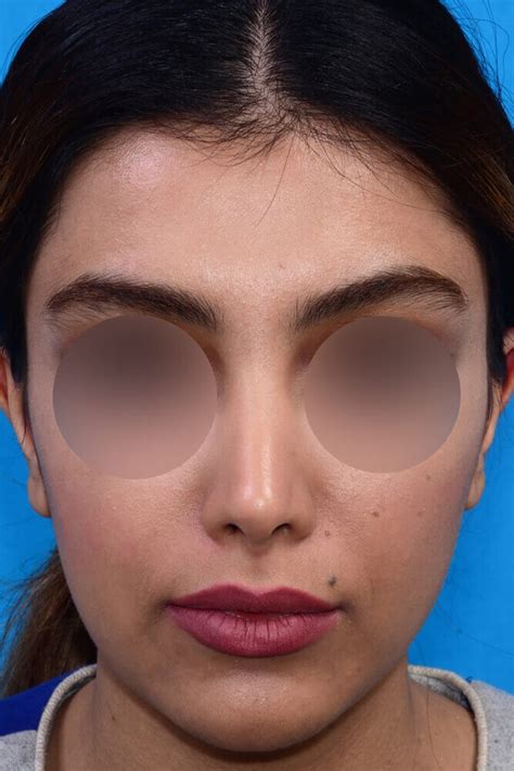 Persian Women Nose Jobs