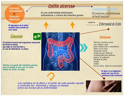 Colitis Ulcerosa Enfermedad Autoinmune Crónica E Inflamatoria