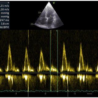 Left Atrial Wall Motion Velocity Lawmv Lawmv Cm S Pulsed Wave