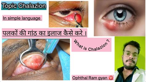 What S Is Chalazion Treatment Of Chalazion Surgery Of Chalazion In Simple Language