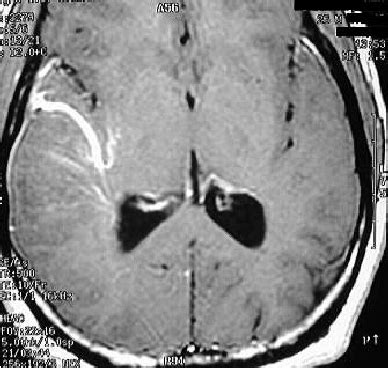 Angio CT – venous angiomas on right side | Download Scientific Diagram