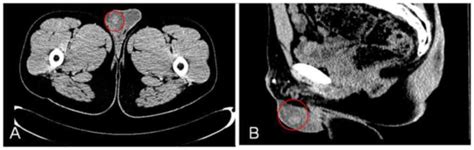 Benign Testicular Cavernous Hemangioma Presenting With Acute Onset A