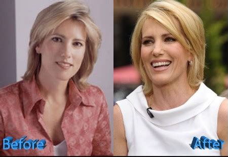 Laura Ingraham Plastic Surgery, "She Had a Facelift," People Claim ...