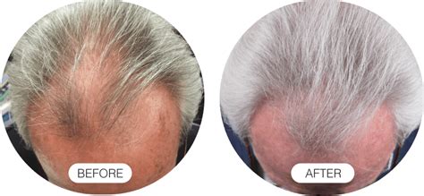 Before And After Results Capillus® Laser Therapy Caps For Hair