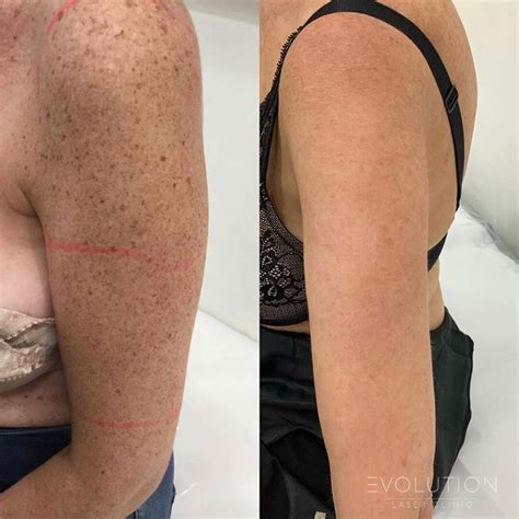 Pigmentation Reduction Sydney Pigmentation Removal Treatment ELC