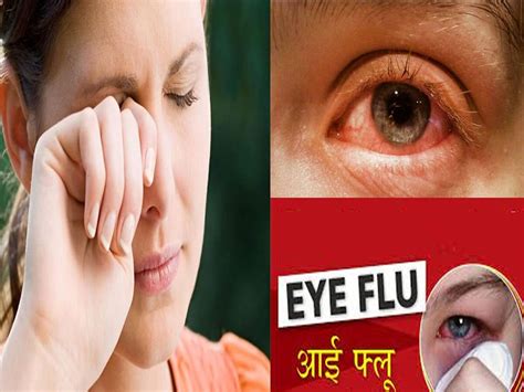 Eye Flu Wreaks Havoc From Delhi Up To Mp Chhattisgarh Thousands Case Every Day Expert Told How