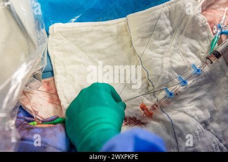 Proceso De Colocaci N De Stent De Coraz N En Sala De Operaciones