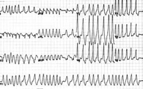 Bizarre Wide Qrs Tachycardia Irregularly Irregular Indicative Of