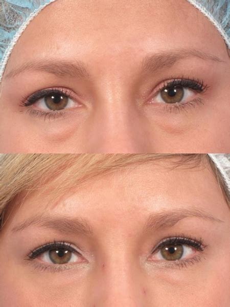 Under Eye Filler Dr Brett Kotlus