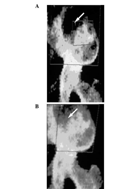 Strontium 89 Therapy For The Treatment Of Huge Osseous Metastases In