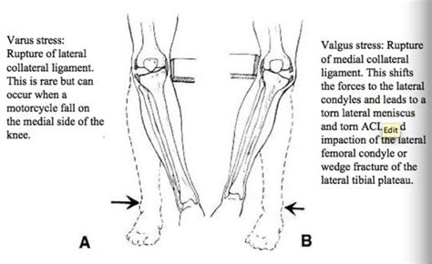 Valgus Stress External Rotation Medial Lig Tear Varus Stress Internal Rotation Lateral