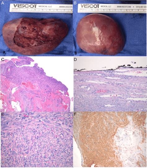 A And B Itraoperatively Obtained Specimen C Myocardial Biopsy With