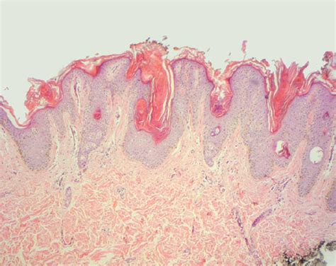 Photomicrograph Of Skin Biopsy Of The Abdomen Reveals Orthokeratotic