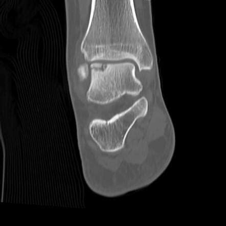 Talus Bone Osteochondral Defect Radiology Case Radiopaedia Org