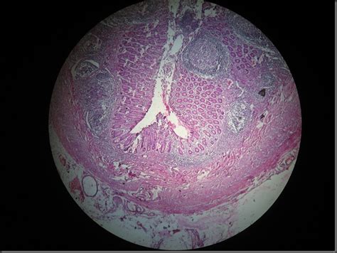 Histology Slides Database: Acute Appendicitis High Resolution Histology Slide