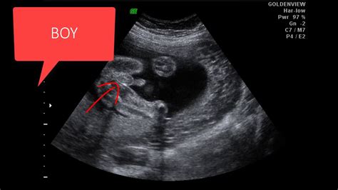 Week Fetus D Ultrasound Buttonlery