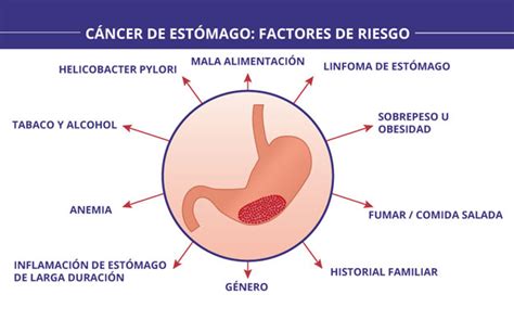 Gastea Cáncer De Estómago Síntomas Y Tratamiento