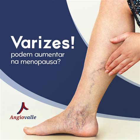 Varizes Podem Aumentar Na Menopausa Angioviva