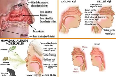 Burun Ak Nt S Nedir Burun Ak Nt S Neden Olur Hanakhaber Tr