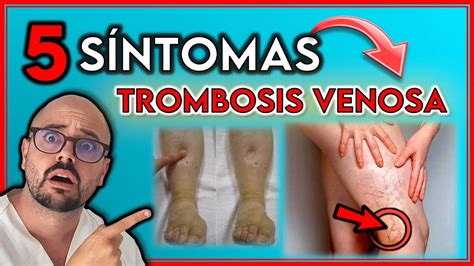 SÍntomas Que Indican Una Trombosis Venosa ¿cómo Prevenir La Trombosis Youtube