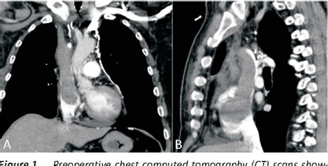 Figure 1 From Surgical Treatment Of An Invasive Thymoma With Intracaval