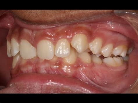 One Year Orthodontic Treatment of Class Ii Div 2 With Deep Bite Unilateral Scissor Bite