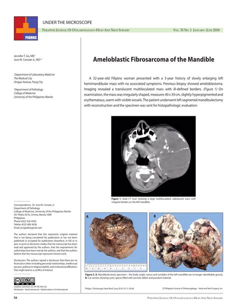 PDF Ameloblastic Fibrosarcoma Of The Mandible