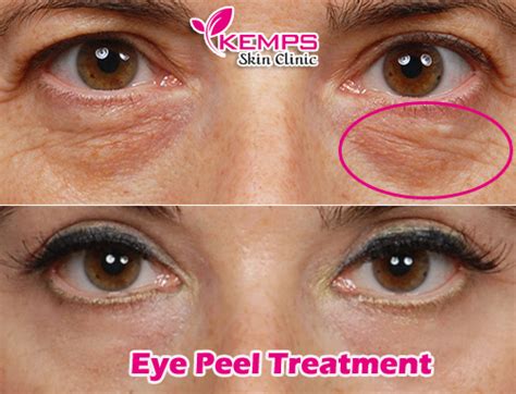 Under Eye Dark Circle Peel Procedure And Benefits Kemps Skin Clinic