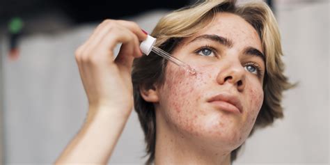 How To Treat Pimples Under The Skin According To Derm Ps Beauty