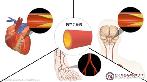 한국지질·동맥경화학회 애니메이션