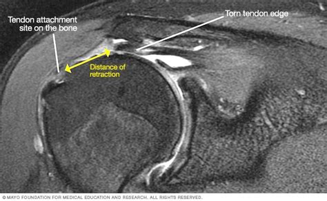 Supraspinatus Tear Mri