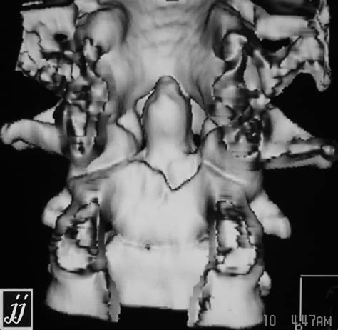 Odontoid Fracture Radiopaedia