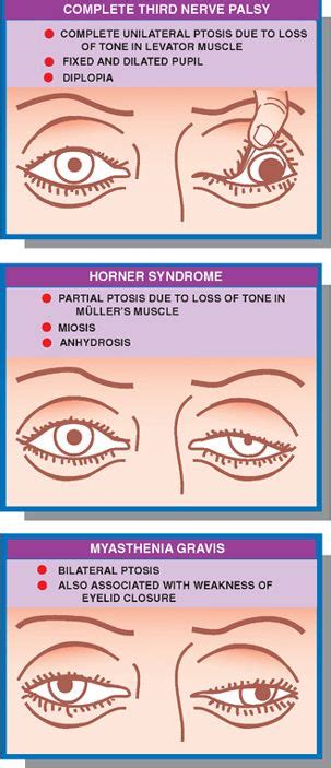 Brainstem Neupsy Key Brain Facts Internuclear Ophthalmoplegia Ocular