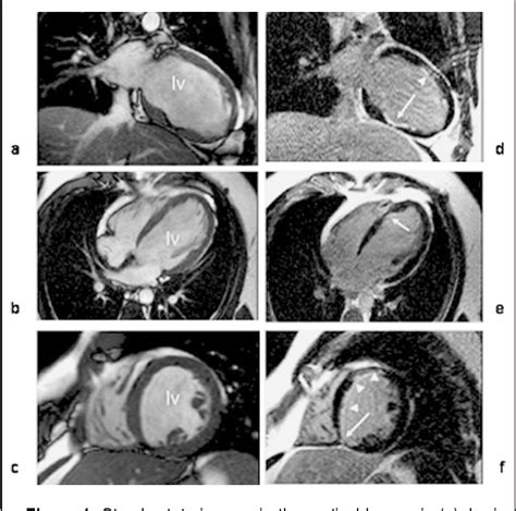 Figure 1 from Follow up in a case of cardiac contusion using ...