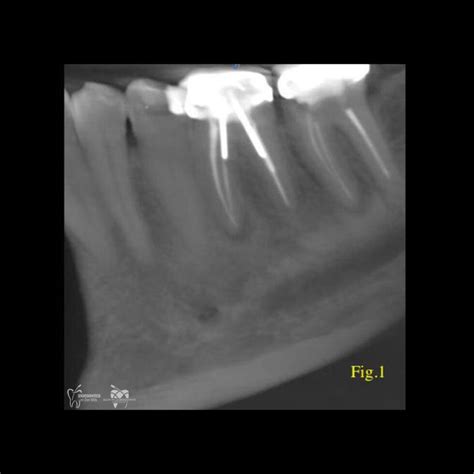 Does Dental Ct Scan Help With The Diagnosis Of A Vertical Root Fracture Pure Practical