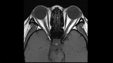 Explore Clinical Images From The Magnetom Portfolio With Deep Resolve