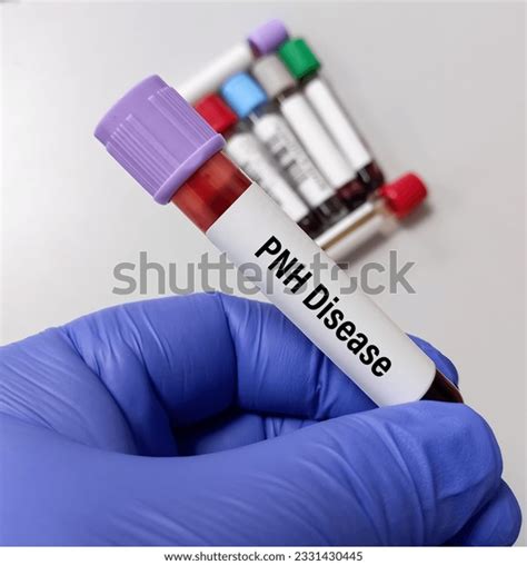 Hemoglobinuria Photos and Images | Shutterstock