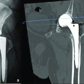 Pdf Cutibacterium Acnes Infection Of Hip Bipolar Hemiarthroplasty