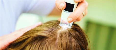 Best Treatment For Scalp Psoriasis | Dr. Seeds Blog