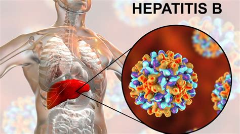 Bisakah Penyakit Hepatitis B Sembuh Total KlikDokter