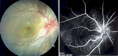 Figure Color Photography And Fluorescein Angiography Statpearls