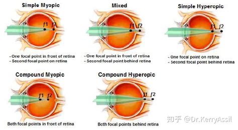 屈光近视手术基础知识科普——仅矫正视力已经过时了 知乎