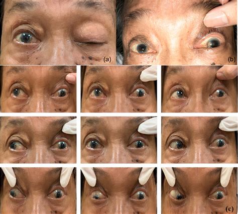 Ocular Manifestations Of Cavernous Sinus Syndrome In Primary Gaze A