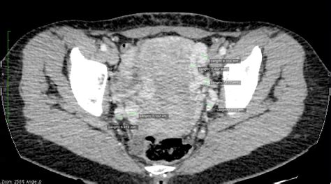 PDF Pelvic Congestion Syndrome And Embolization Of Pelvic Varicose