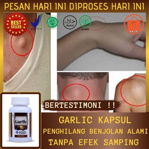 Jual Obat Pengempis Benjolan Kelenjar Getah Bening Benjolan Di Leher